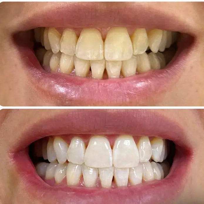 Bandes Éclat Express V34 – Blanchiment Dentaire Instantané Sans Peroxyde | Smile Addict Smile Addict