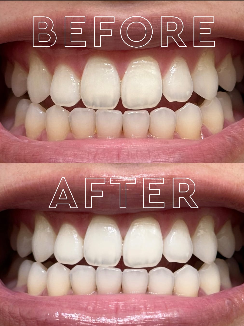 PACK ROUTINE EXPRESS BLANCHEUR — PACK BEST-SELLER SMILE ADDICT - Smile Addict