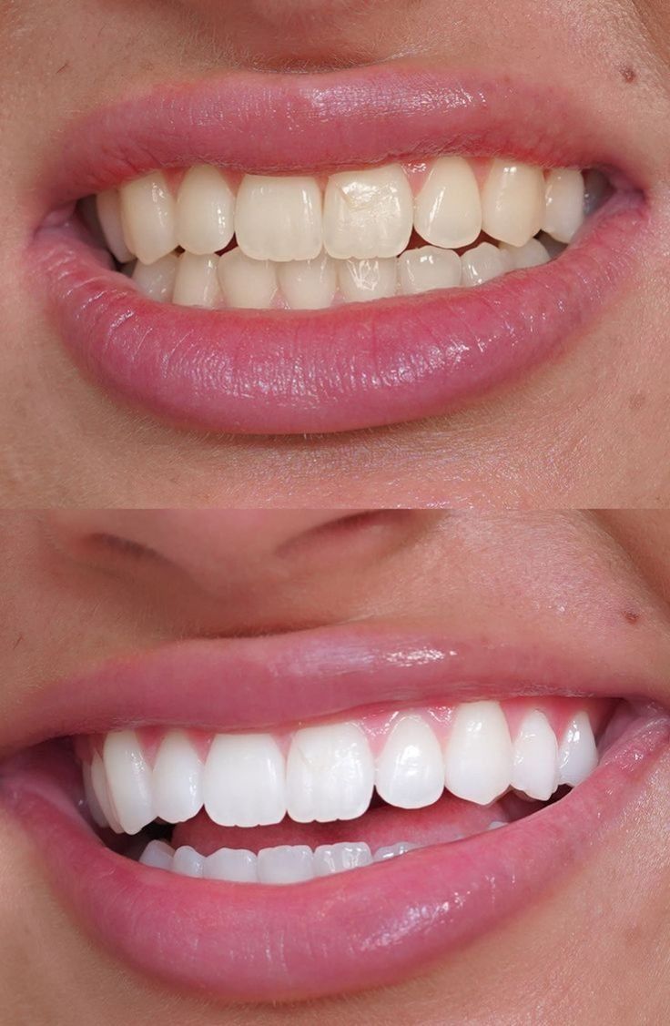 Whitening strips - New PAP+ formula Mint flavored